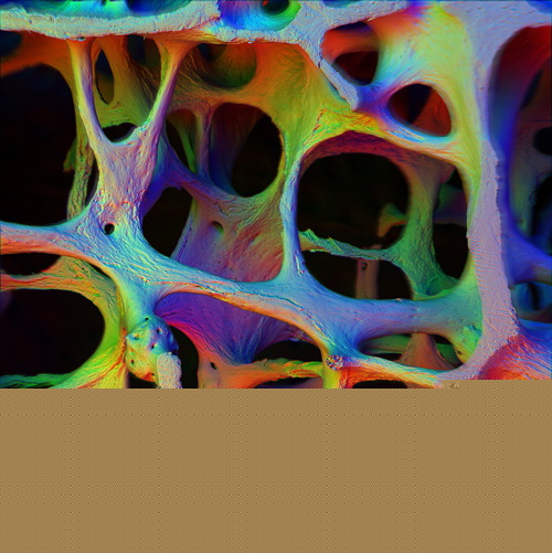 Osteoporosis.
